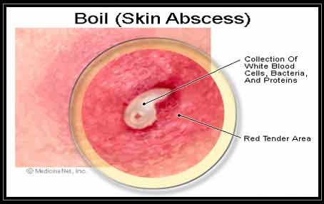 Illustrator of Boil Skin Infection