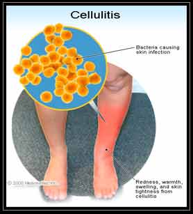 Illustrator of Cellulitis Skin Infection