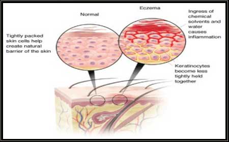 Eczema