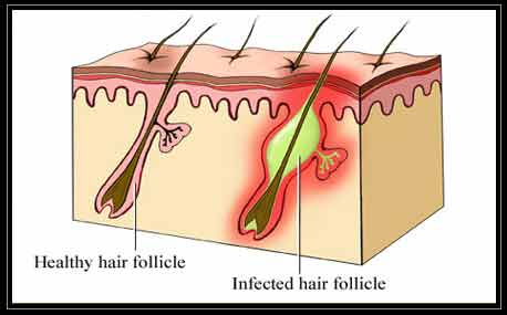 Illustrator of Folliculitis Skin Infection