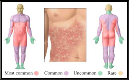 Image of Hives on human body