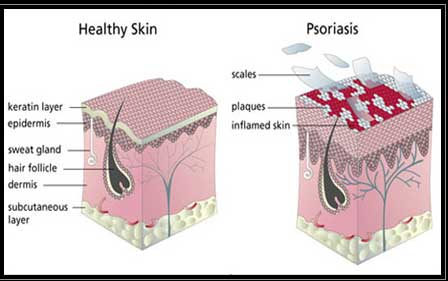 Psoriasis kezelése hindi