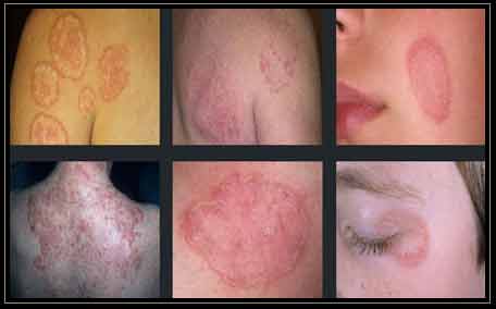 Ringworm Skins Infections Collage pictures