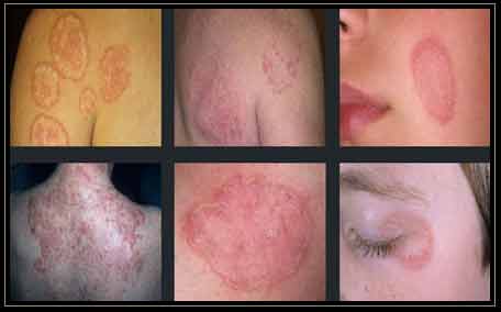 Tinea corporis