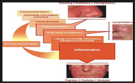 Rosacea