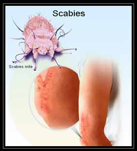 Illustrator of Scabies Skin Infection