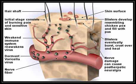 Illustrator of Shingles Skin Infection